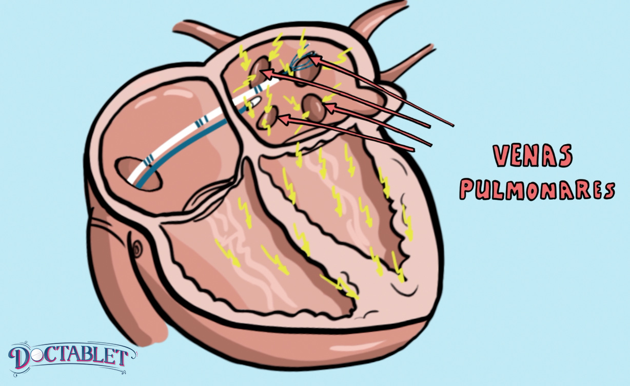La ablación de FA se enfoca en las venas pulmonares.