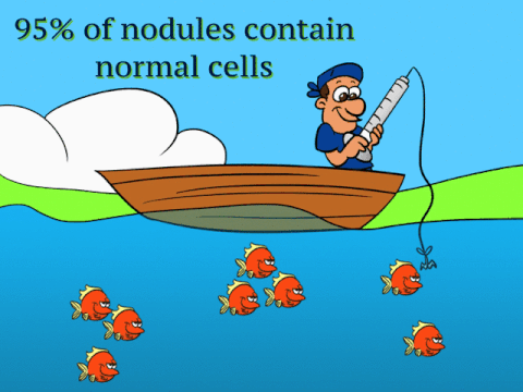 Thyroid biopsy results: 95% of thyroid nodules are filled with healthy normal cells.