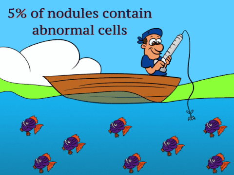 Thyroid biopsy results: 5% of all thyroid nodules have abnormal cells within them.