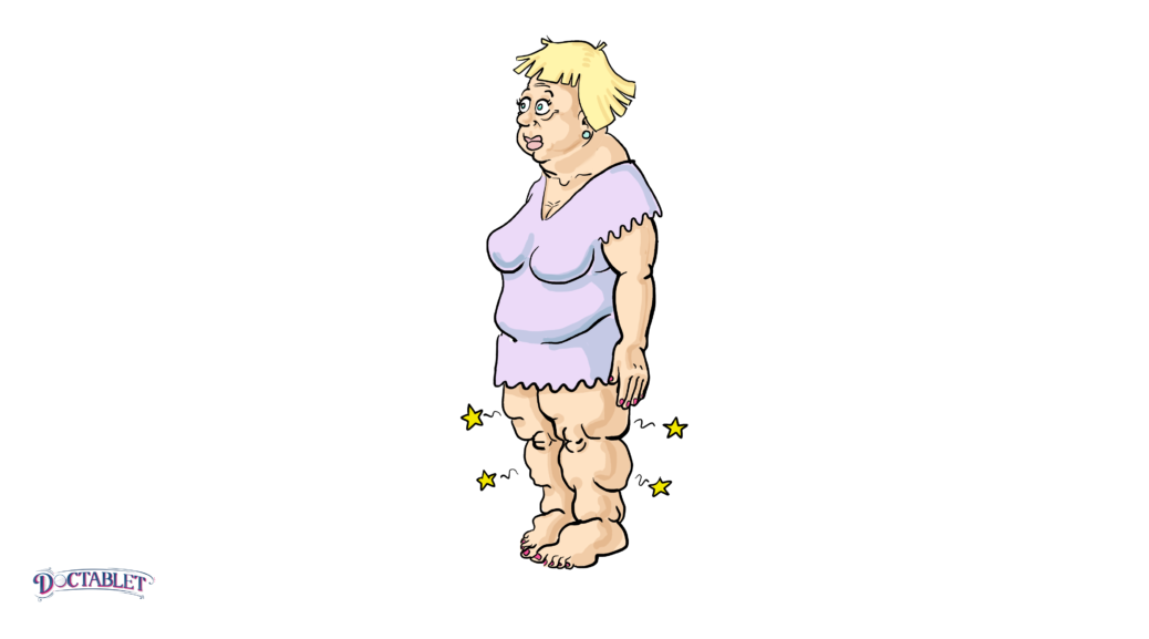 Leg swelling caused by congestive heart failure