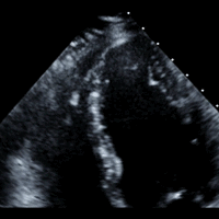 Heart at stress in a stress echocardiogram