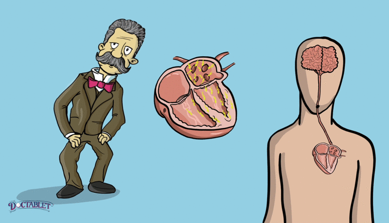 FA causa síntomas y aumenta la posibilidad de un derrame cerebral