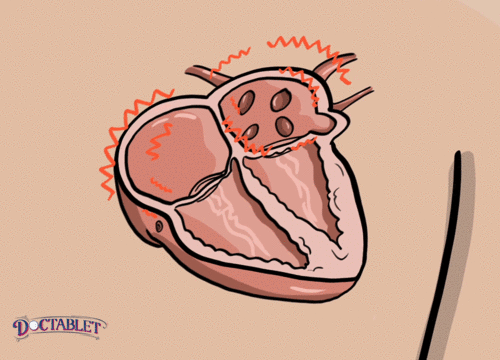 Que es la FA? un ritmo cardíaco anormal