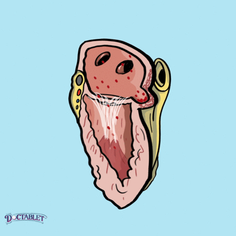  Cómo la fibrilación auricular provoca derrames, la sangre se asienta en el apéndice-cola