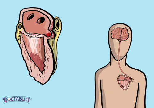 Apéndice-cola puede exprimir los coagulos hacia el cuerpo y provocar un derrame.